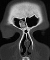 Osteom der Stirnhöhle in der Computer­tomo­graphie