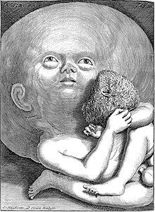 Gravure d'un enfant hydrocéphale tenant son placenta