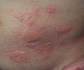 Pomfo, orticaria