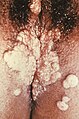الزهري الثانوي تظهر آفات لأورام لقمية في العجان، والذي يظهر كحطاطات رمادية مرتفعة والتي تظهر في بعض الأحيان على الفرج أو بالقرب من فتحة الشرج، أو في أي منطقة أخرى مذحية.