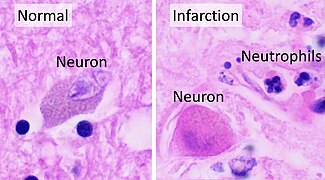 In stroke, they are beginning to infiltrate the infarcted brain after 6 to 8 hours.[63]