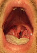 Miệng mở rộng cho thấy cổ họng Nhiễm trùng họng mà trên nền văn hóa đã xét nghiệm dương tính với liên cầu nhóm A. Lưu ý các amidan lớn với chất tiết màu trắng.