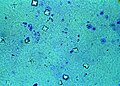 Urine microscopy showing calcium oxalate crystals in the urine. The octahedral crystal morphology is clearly visible.