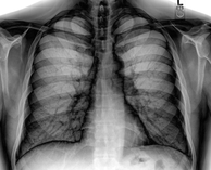 Chest X-ray PA inverted and enhanced.