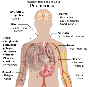 肺炎主要症狀的人體示意圖