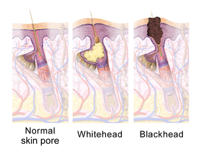 Illustration of hair follicle anatomy demonstrating a healthy hair follicle (pictured left), a whitehead or closed comedone (middle picture), and a blackhead or open comedone (pictured right)