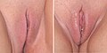 左圖為未興奮的外陰，右圖則為性興奮中的外陰，其潤滑、充血、陰唇增大並富有光澤。