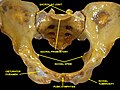 Anterior view of the pelvis with the ischial tuberosity labelled in the lower part of the image