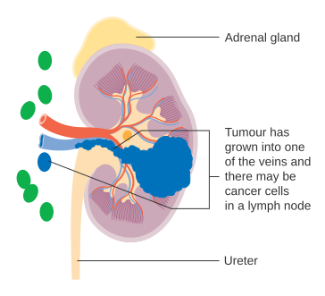 Stage 3 kidney cancer