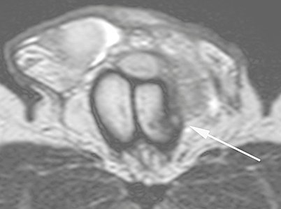 B: Axial T2-weighted turbo spin-echo magnetic resonance imaging scan showing left-sided discontinuity of the tunica albuginea (arrow), secondary to fracture.[2]