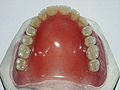 Complete Upper Denture