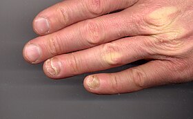 انفكاك الأظافر في اليد اليسرى. الإصبعان البنصر والأوسط مصابان.
