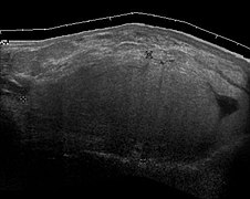 Ultrasonography of a liposarcoma mimicking lipoma. A homogeneous hypoechoic mass presenting with the same appearance of lipoma. It was clinically distinguished by having rapid growth.[24]