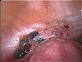 Endometriose auf dem Bauchfell zwischen Blase und Gebärmutter (Entfernung unter Erhalt der Gebärmutter möglich)