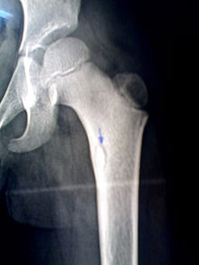 Bony sequestrum in a child femur.jpg