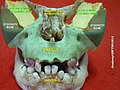 Greater wing of sphenoid bone