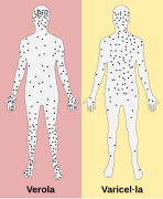 Smallpox versus chickenpox-ca.svg