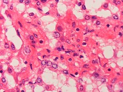 Adenovirus infection Case 161 (5443939520).jpg