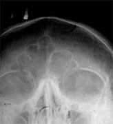 Radiografía frontal dos seos frontais
