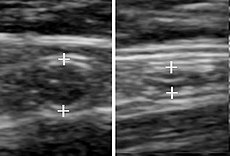 A normal appendix without and with compression. Absence of compressibility indicates appendicitis.[98]