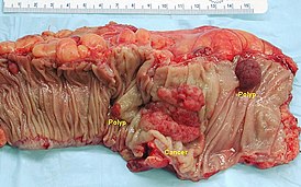 Образец части толстой кишки, содержащей два аденоматозных полипа и инвазивную карциному.