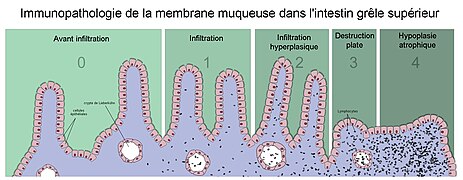 Coeliac Disease fr.jpg