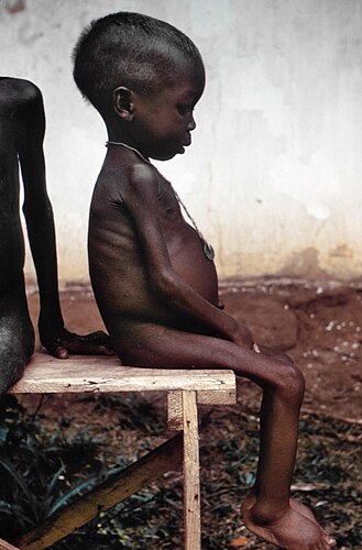 Ребёнок, больной детской пеллагрой, в лагере для беженцев во время Нигерийской гражданской войны (1967 — 1970)