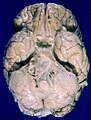 Human brain bottom view. Orbital gyri not labelled, but seen at top.