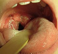Một bộ amidan lớn ở phía sau cổ họng, phủ đầy màu trắng. Một trường hợp dương tính với văn hóa của viêm họng do liên cầu khuẩn với amidan điển hình xuất tiết ở một đứa trẻ 8 tuổi.
