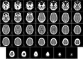 人腦的電腦斷層掃描 （Computed tomography of human brain