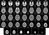 Computed tomography of human brain, from base of the skull to top.