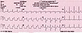 Electrocardiograms