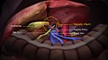 Fotograma de animación médica en 3D que representa partes do fígado