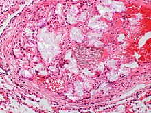 Celulosa microcristalina - Polarizada - Embolización pulmonar