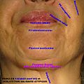 Fig.3. Déglutition salivaire dysfonctionnelle chez l'adulte et contributions atypiques du nerf facial (n.VII) dans l'étude d'une dysfonction des mâchoires (DAM).