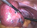 Adenomyosis uteri (Endometriose der Gebärmutterwand – gebärmuttererhaltende Operation meist nicht möglich)