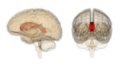 Corpus callosum sa anatomografijom