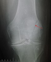Vertical patella fracture