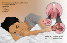 Infección respiratoria aguda