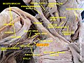 Right subclavian artery