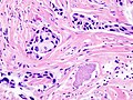 Histopathology of invasive ductal carcinoma of the breast representing a scirrhous growth. Core needle biopsy. Hematoxylin and eosin stain.