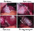 Cholecystectomy seen through a laparoscope