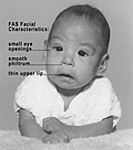 Thumbnail for Fetal alcohol spectrum disorder