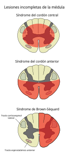 Lesiones incompletas de la médula