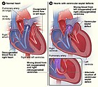 Beispiel: Vergleich eines normalen Herzes (links) und eines mit Ventrikelseptumdefekt (rechts). Der hier abgebildete Herzfehler ermöglicht in zwei häufigen Fällen das Vermischen von sauerstoffreichem und sauerstoffarmen Blut. Dies kann in einer Herzkammer selbst und/oder an ihrer Scheidewand passieren.