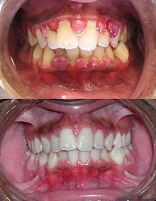 דלקת חניכיים, לפני ואחרי טיפול שיניים