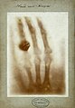 Eines der ersten Röntgenbilder aus dem Jahr 1895