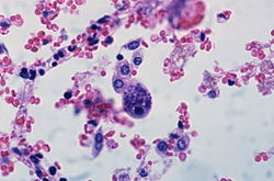 Дія цитомегаловірусу в клітинах (є базофільні ядерні включення з околоядерним просвітленням і гранулами базофільних включень в цитоплазмі клітин посередині слайда) (мікропрепарат (фото), фарбування гематоксиліном-еозином).