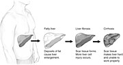 Thumbnail for Metabolic dysfunction–associated steatotic liver disease