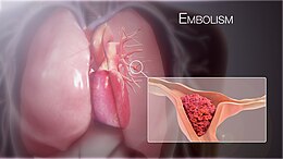 Description de l'image 3D Medical Animation still shot Pulmonary Embolism.jpg.